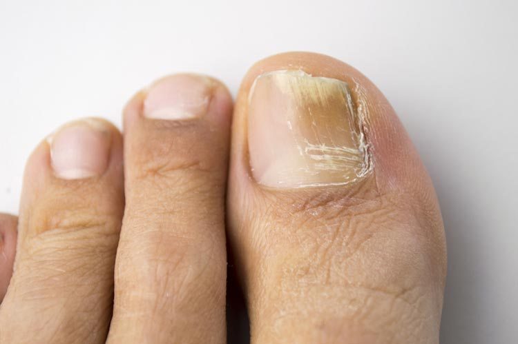 Nail Fungal Infections
